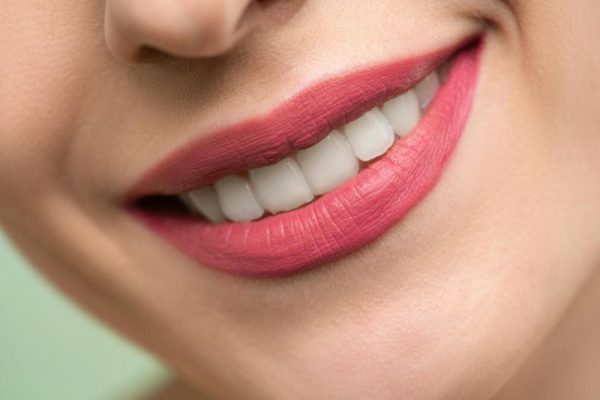 dental veneers Ashgrove