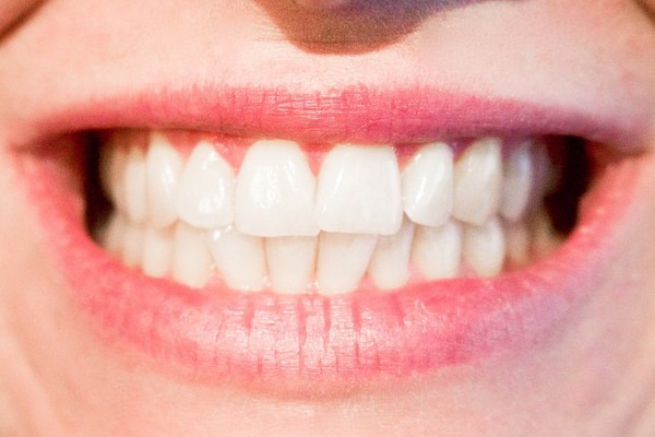 teeth whitening dentist brisbane