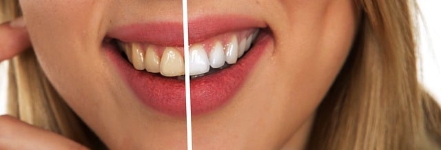 teeth whitening results